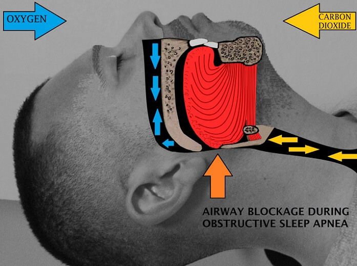 sleep apnea