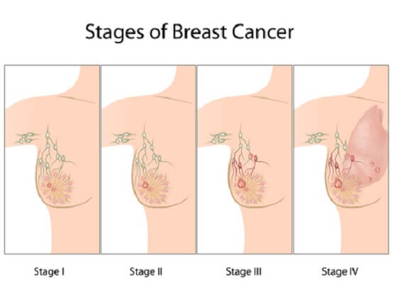 PRS breast cancer