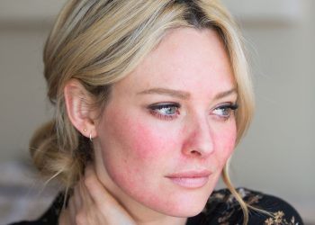 Rosacea: causes and methods of treatment