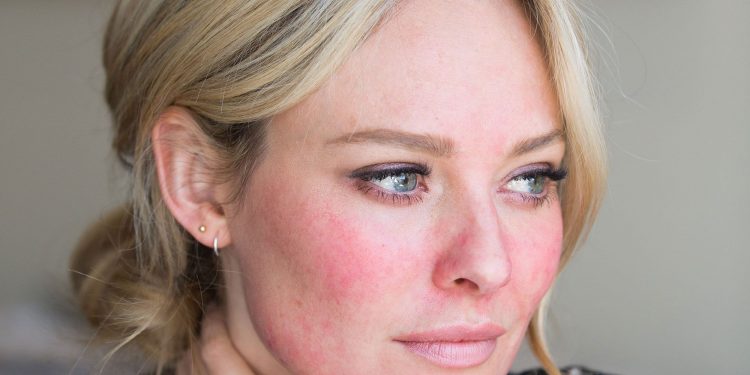 Rosacea: causes and methods of treatment