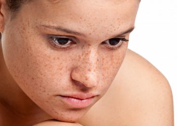 The 7 best natural remedies for getting rid of dark spots