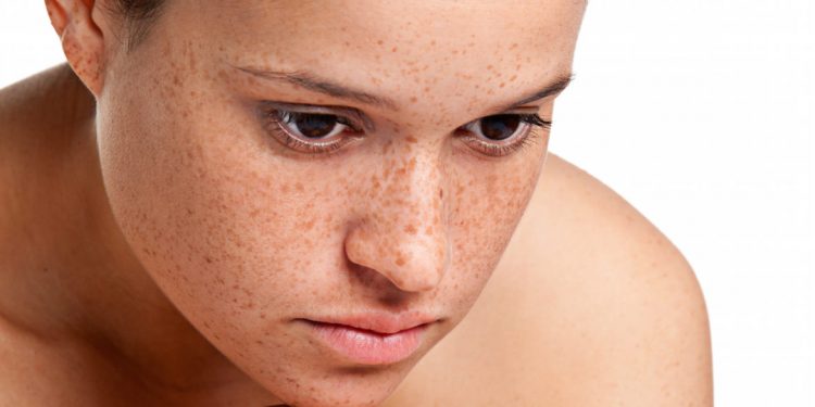 The 7 best natural remedies for getting rid of dark spots